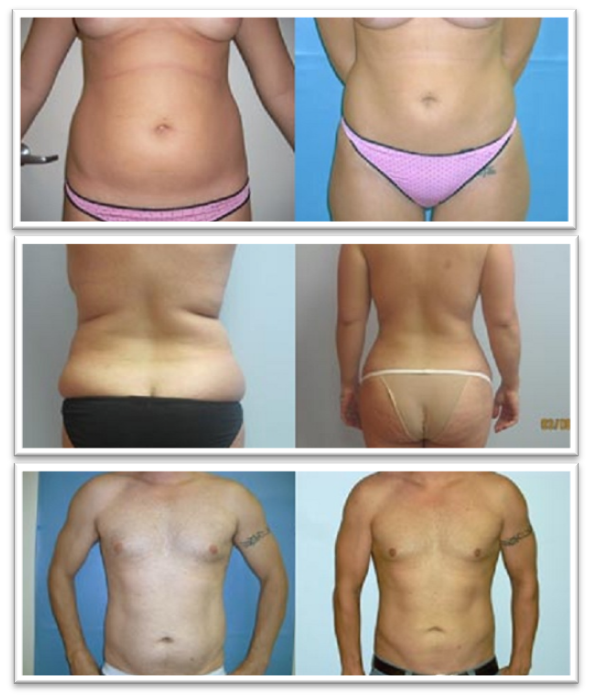 Abdominal Liposuction - KleinLipo - Liposuction Surgery of Orange