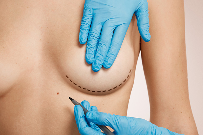Breast surgery procedures by Dr. Haley Carpenter in Coral Springs, FL