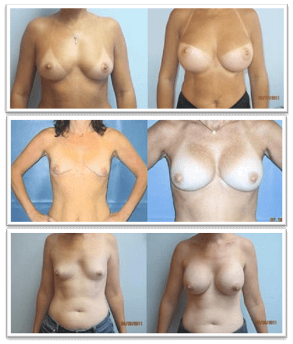 Breast surgery procedures by Dr. Haley Carpenter in Coral Springs, FL Breast surgery procedures by Dr. Haley Carpenter in Coral Springs, FL