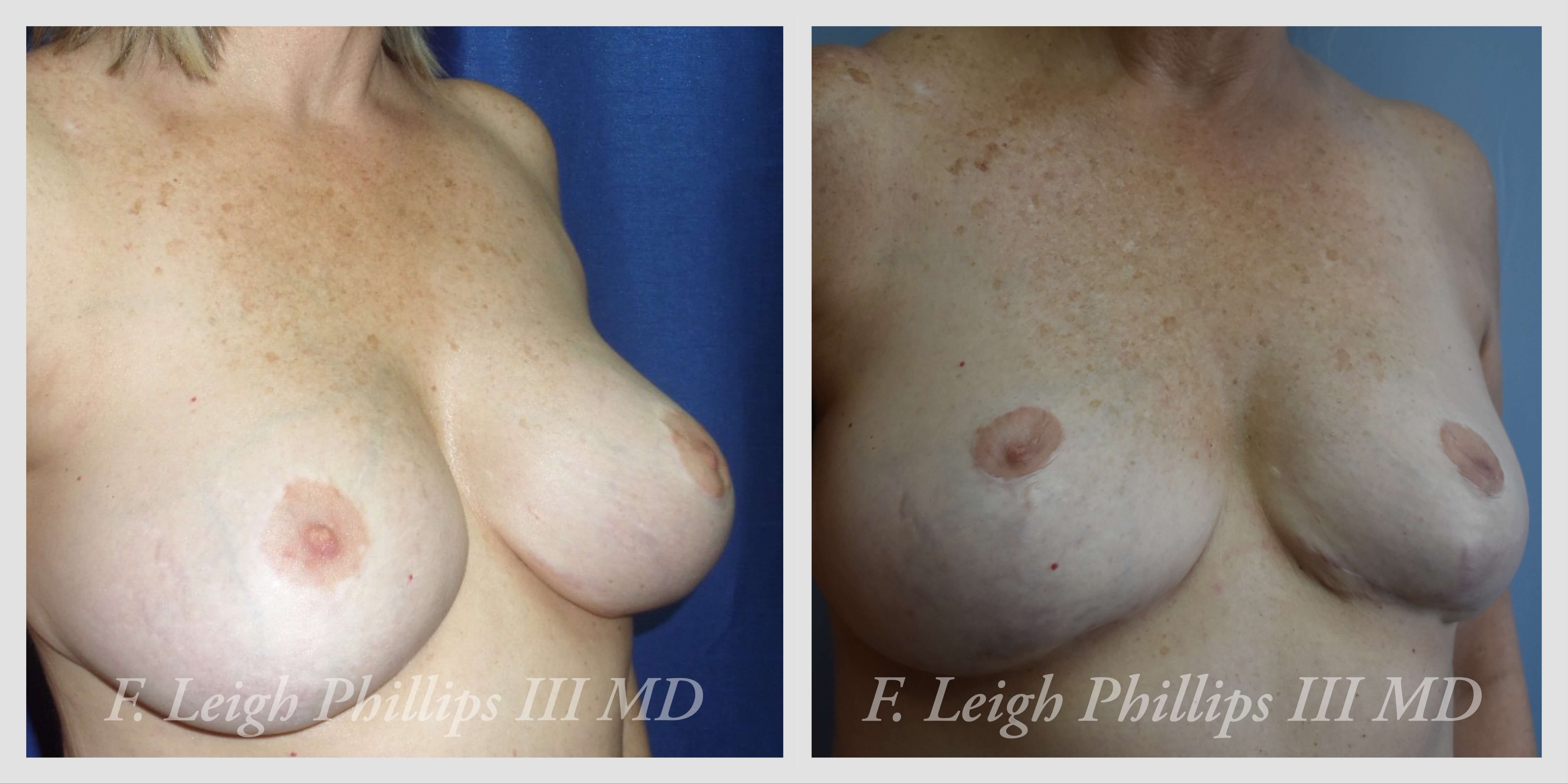 Breast surgery procedures by Dr. Haley Carpenter in Coral Springs, FL