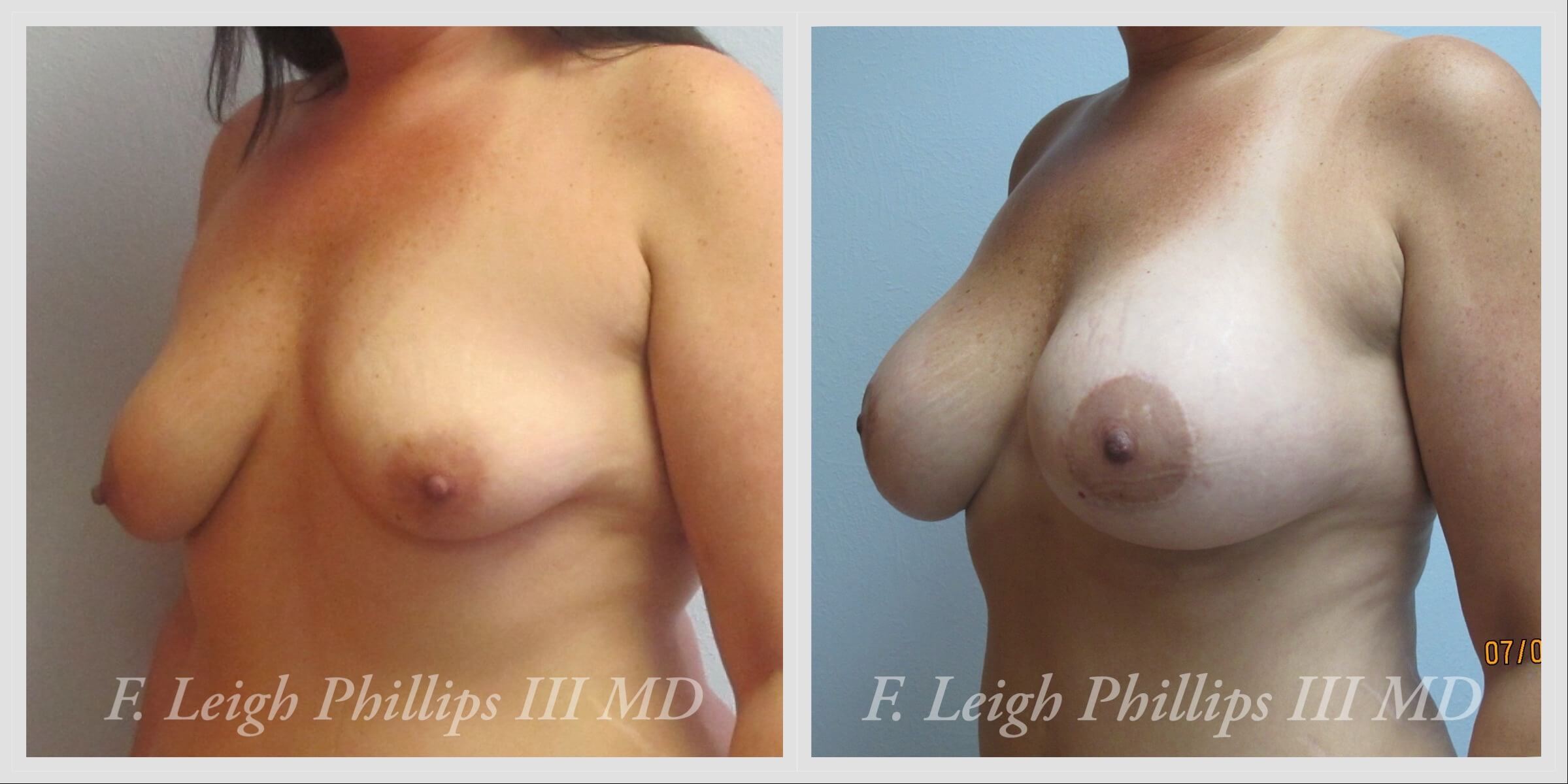 Breast surgery procedures by Dr. Haley Carpenter in Coral Springs, FL