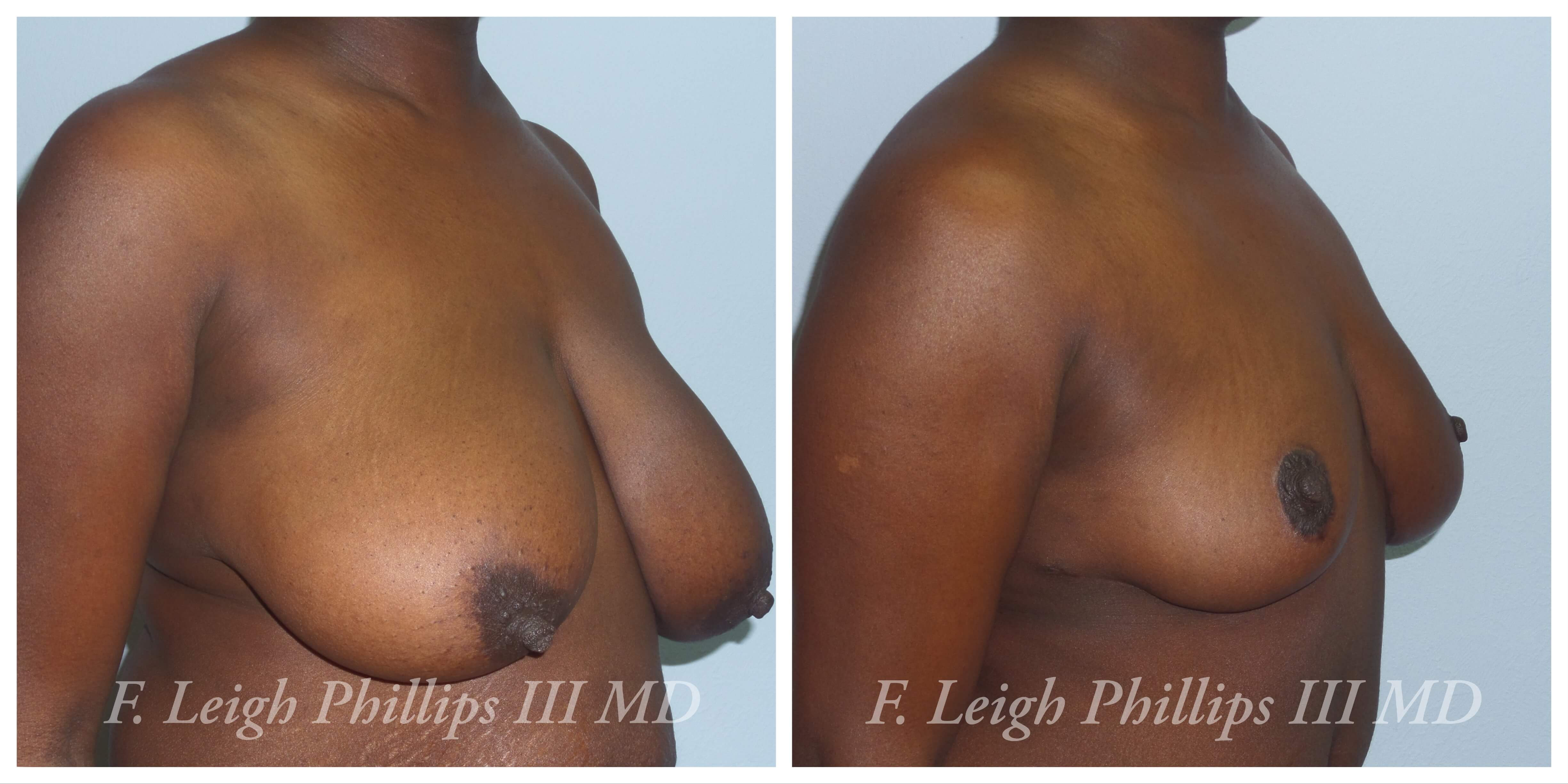 Breast surgery procedures by Dr. Haley Carpenter in Coral Springs, FL