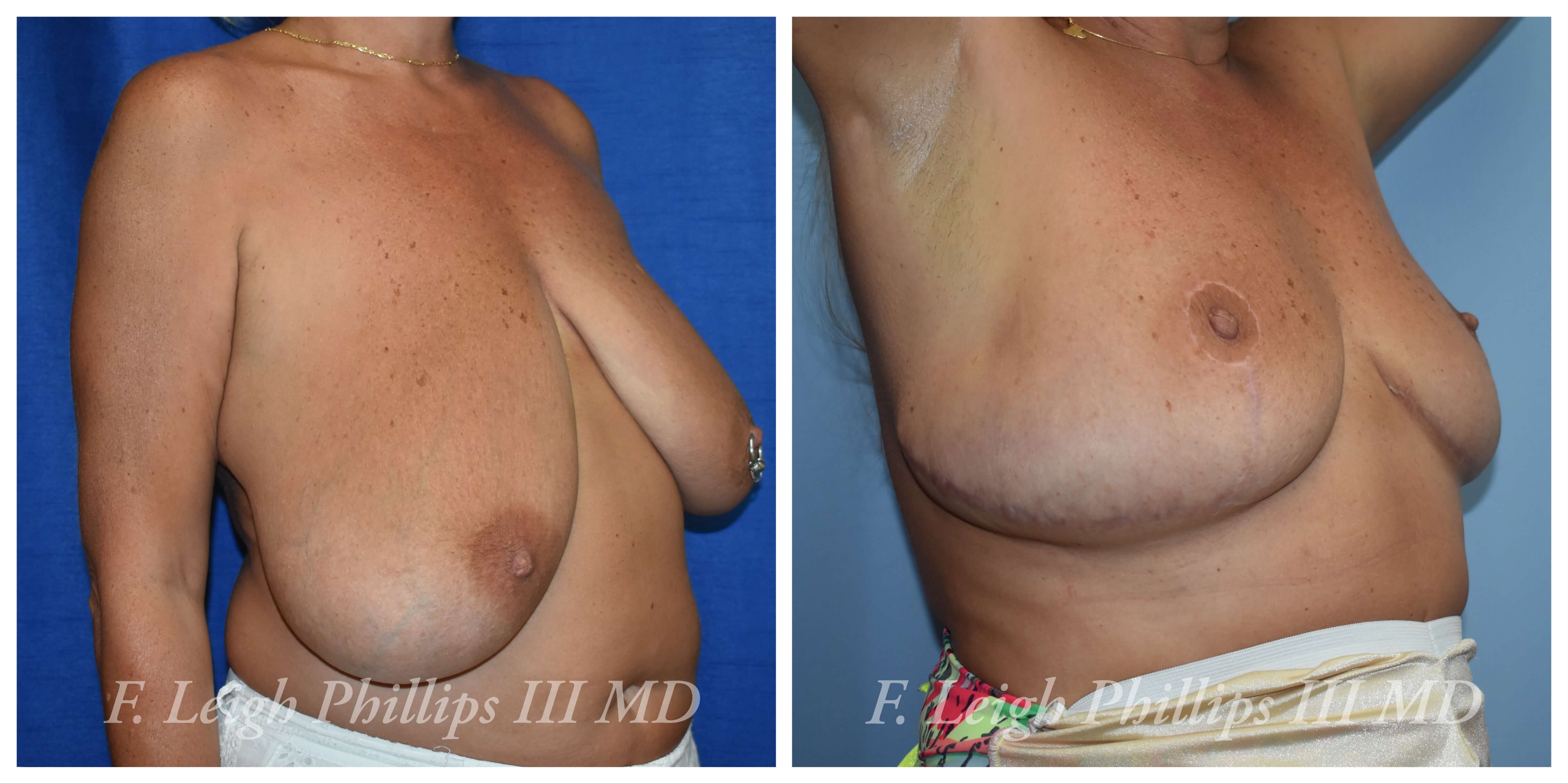 Breast surgery procedures by Dr. Haley Carpenter in Coral Springs, FL