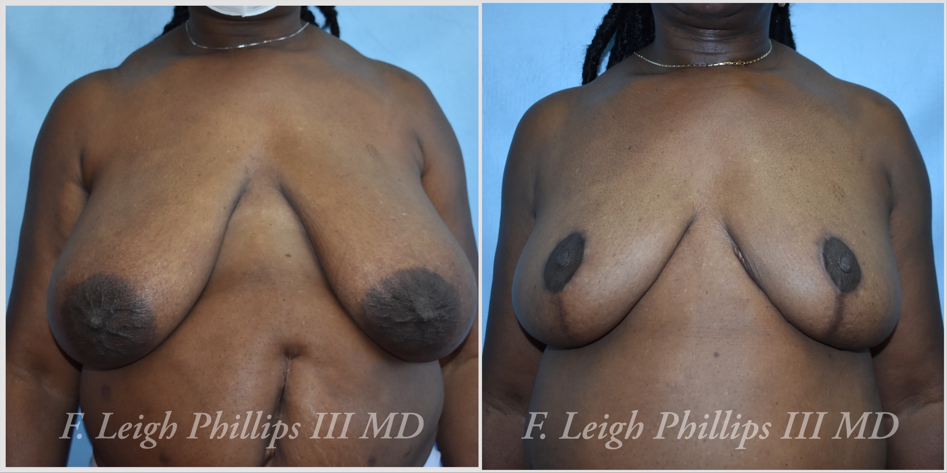 Breast surgery procedures by Dr. Haley Carpenter in Coral Springs, FL