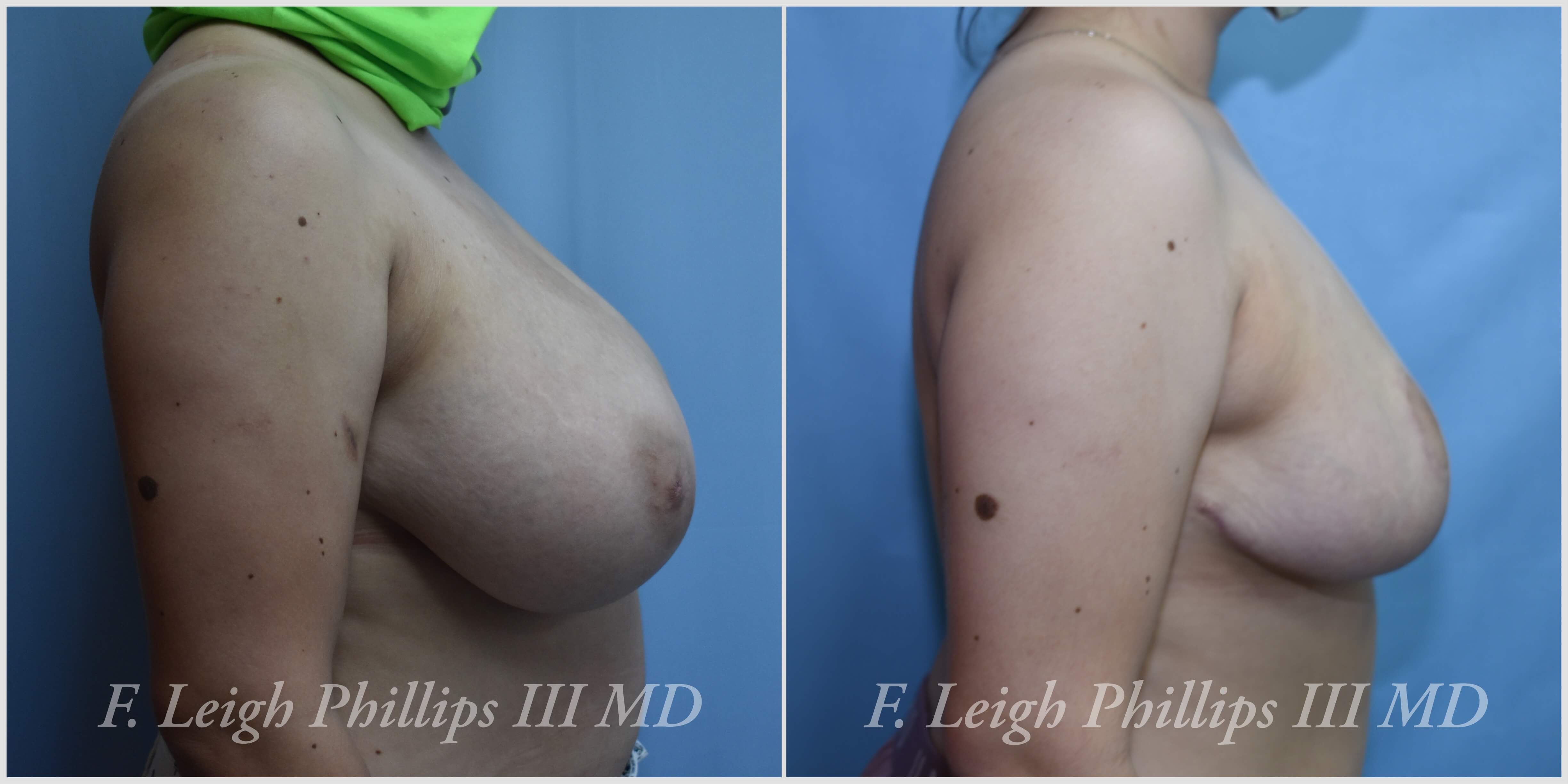 Breast surgery procedures by Dr. Haley Carpenter in Coral Springs, FL